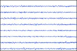 Epilepsy